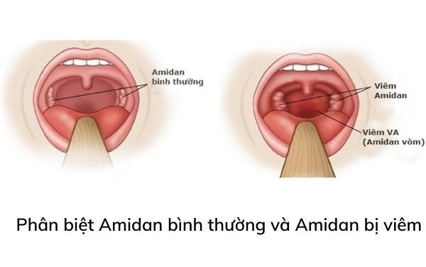 Amidan là gì? Nguyên nhân gây viêm Amidan?