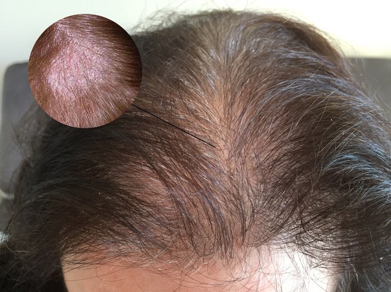 6 nguyên nhân da đầu bị nhiều gàu vào mùa đông và cách khắc phục gàu da đầu
